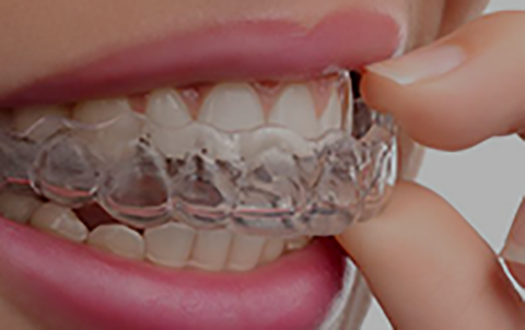 invsialign the clear alternative to braces